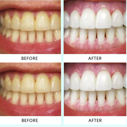 Teeth Whitening Strips (box3)
